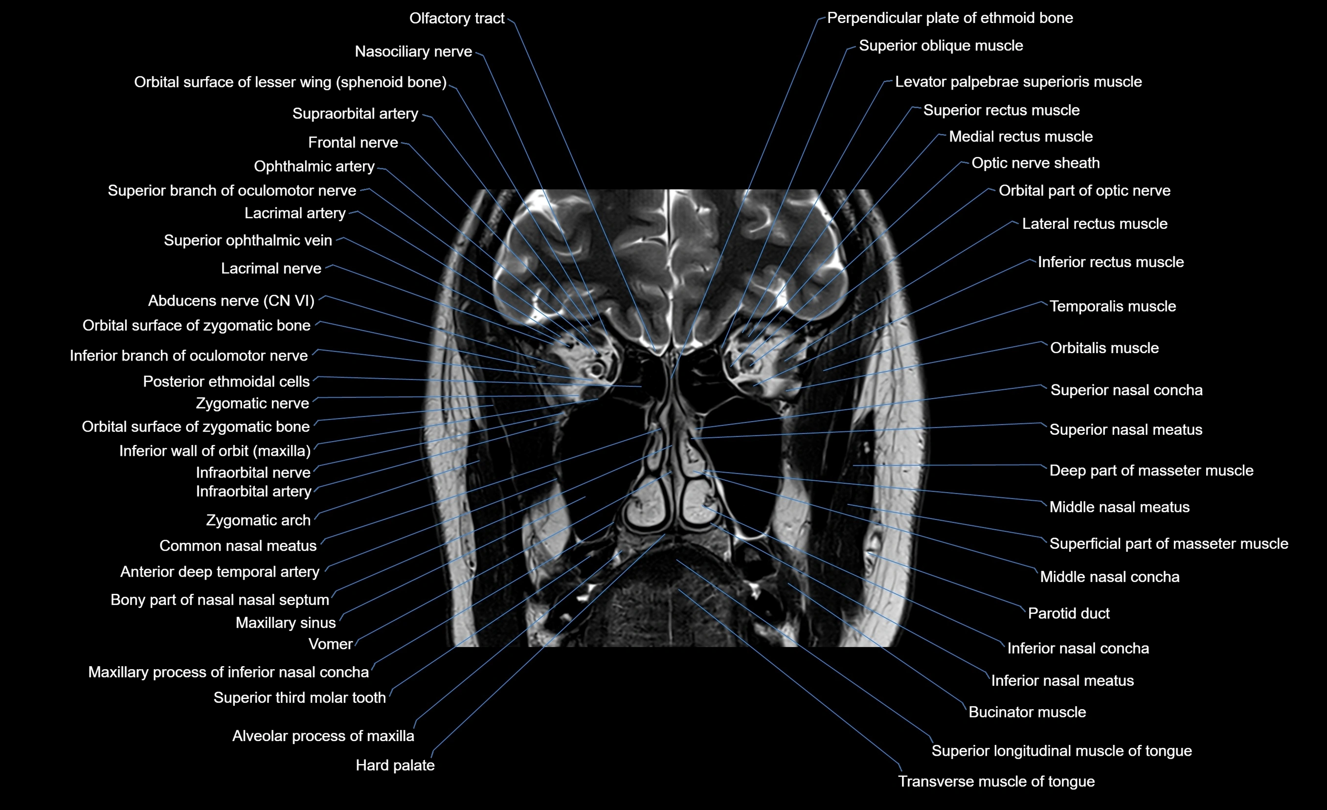 MRI face & paranasal sinuses(PNS) labelled  coronal  cross sectional anatomy 3T radiology  image-img-00001-00025.webp